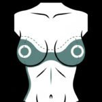 les cicatrices d'un lifting des seins